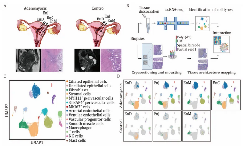 文献解读 | 整合单细胞 RNA 测序和空间转录组学破译人类子宫腺肌症的全面转录图谱
